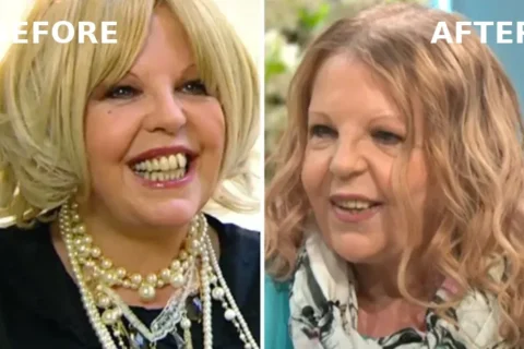 Sally Thomsett Face Illness